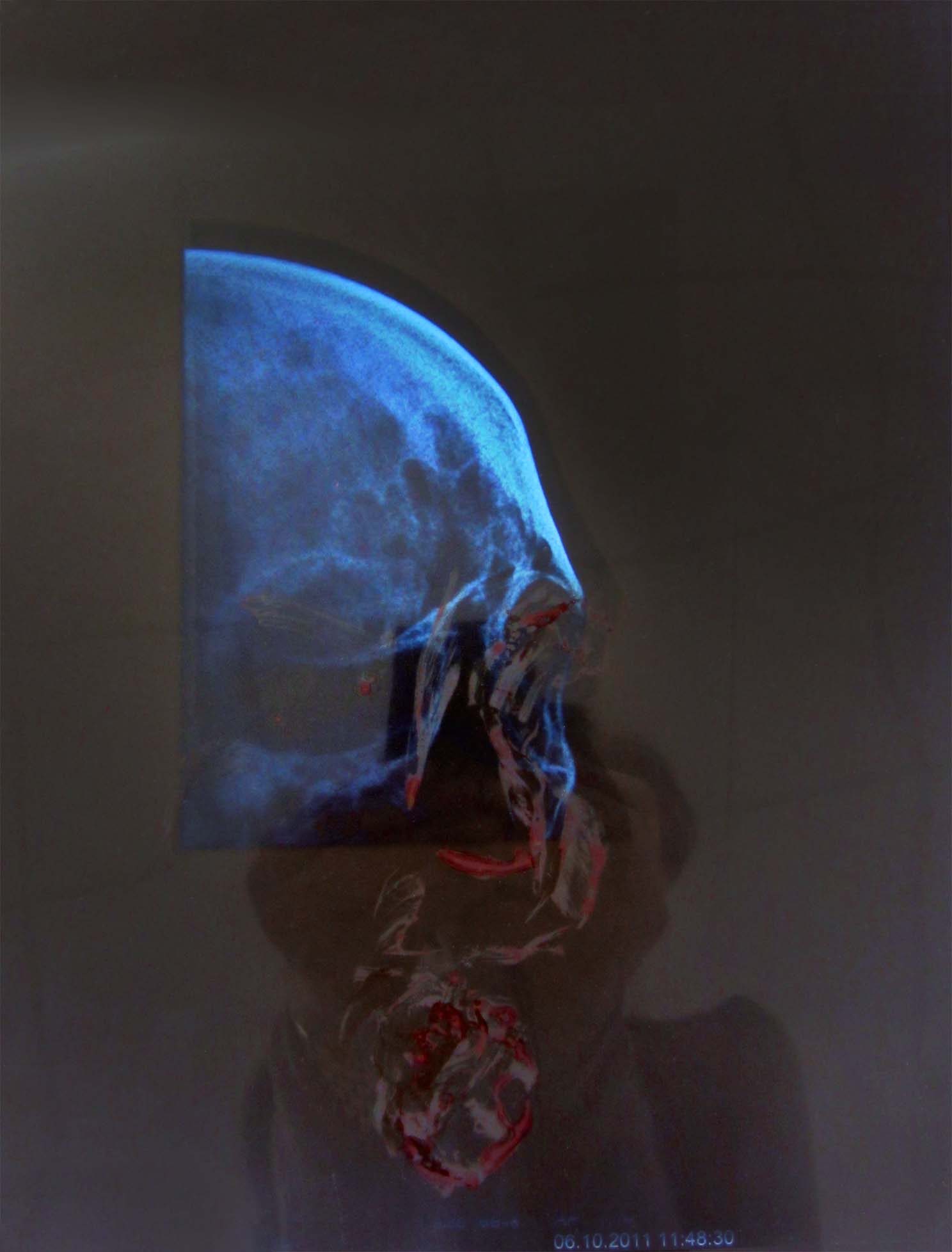 Self portrait with my blood on anonymous skull x-ray
